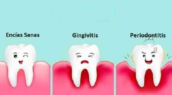 Encías Sanas - Gingivitis - Periodontitis