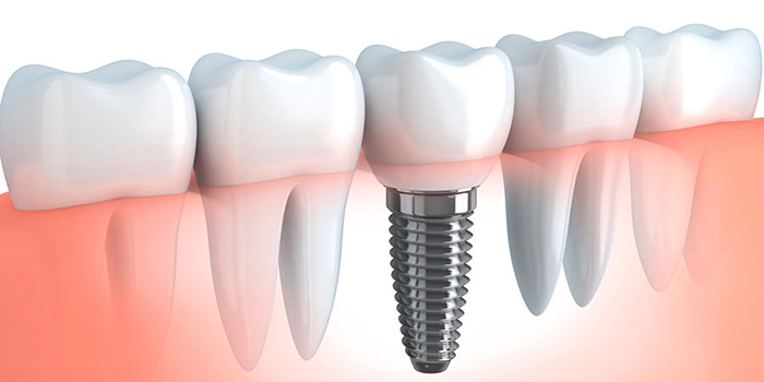 ¿Necesito un Implante Dental? - Periodoncia Mérida