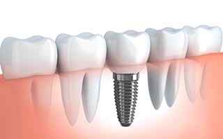 Implantes Dentales - HC Odontologos - Clinica Dental en Merida