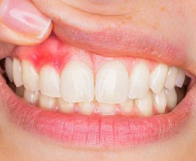 Porque me sangran las encías? - Periodoncia Merida