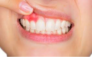 gingivitis - HC Odontologos - Clinica dental en merida