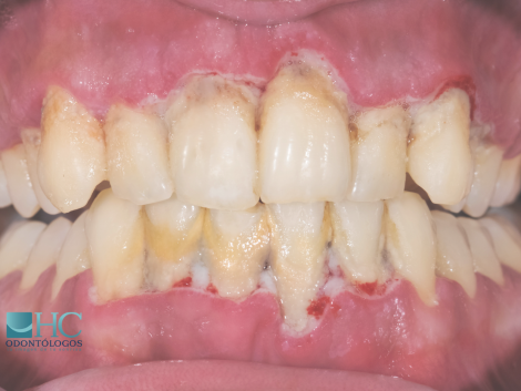 ¿Qué es la periodontitis? - Dra Arelly Carrillo Especialista en Periodoncia - Periodoncia Merida