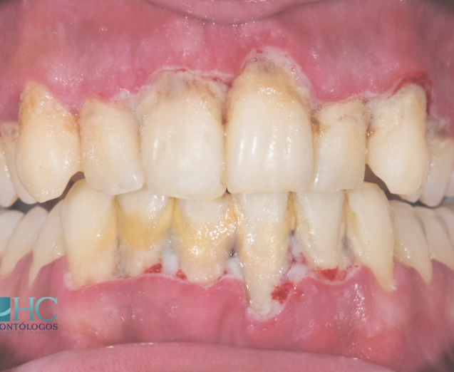 ¿Qué es la periodontitis? - Dra Arelly Carrillo Especialista en Periodoncia - Periodoncia Merida