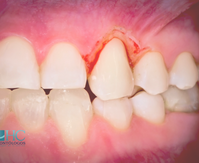 ¿Qué es un periodoncista Enfermedades y tratamientos - Dra Arelly Carrillo Especialista en Periodoncia - Periodoncia Merida
