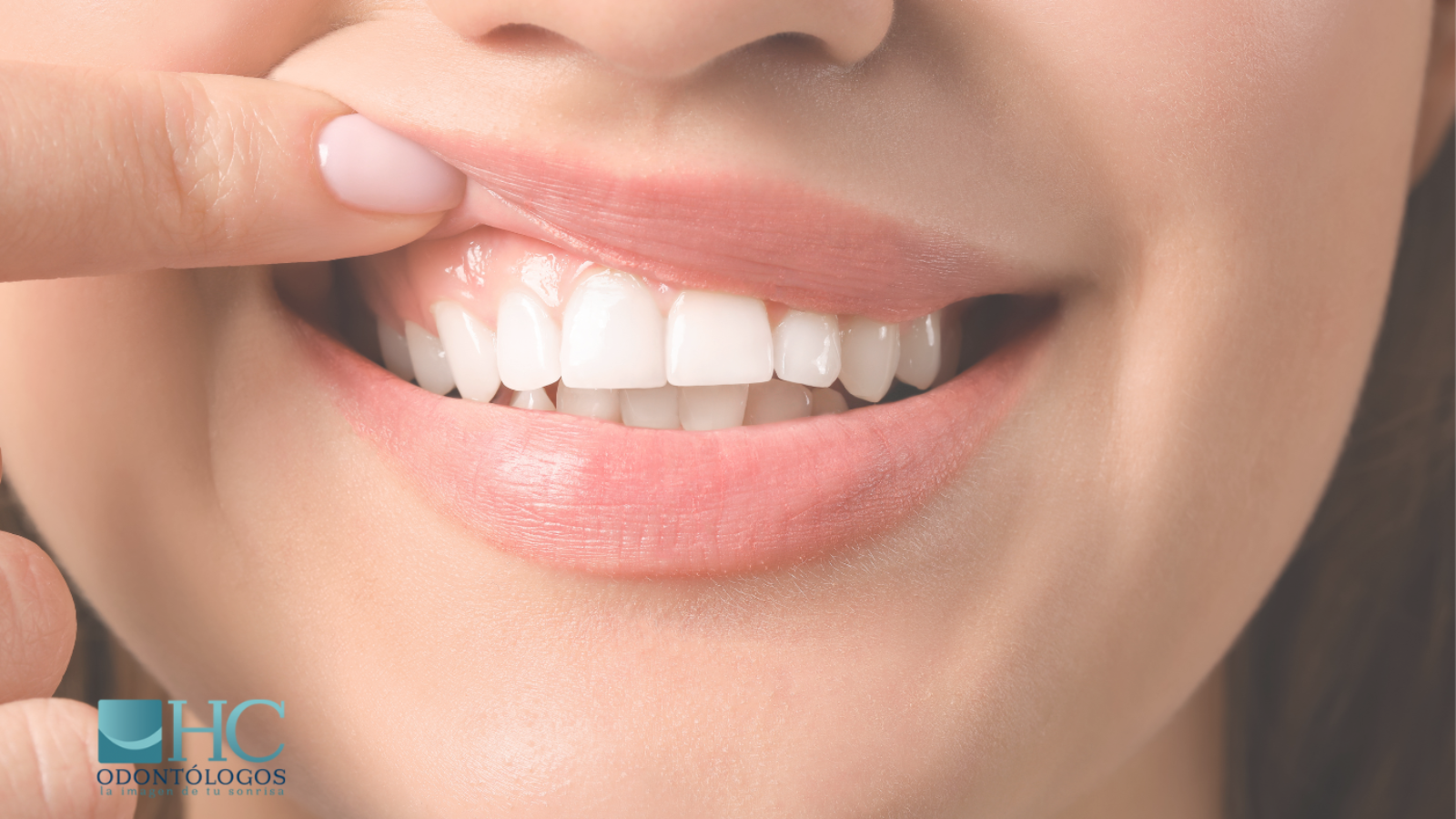 ¿Tus encías están sanas? ¡Descúbrelo aquí! - Dra Arelly carrillo - periodoncia merida