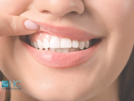 ¿Tus encías están sanas? ¡Descúbrelo aquí! - Dra Arelly carrillo - periodoncia merida