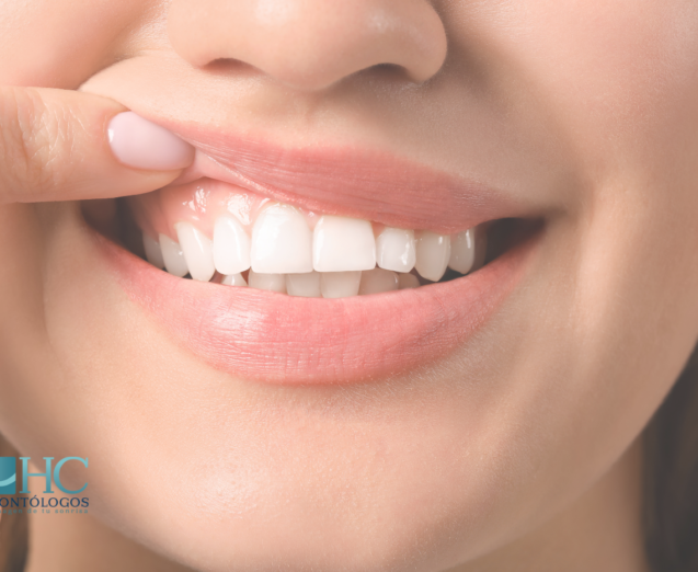 ¿Tus encías están sanas? ¡Descúbrelo aquí! - Dra Arelly carrillo - periodoncia merida